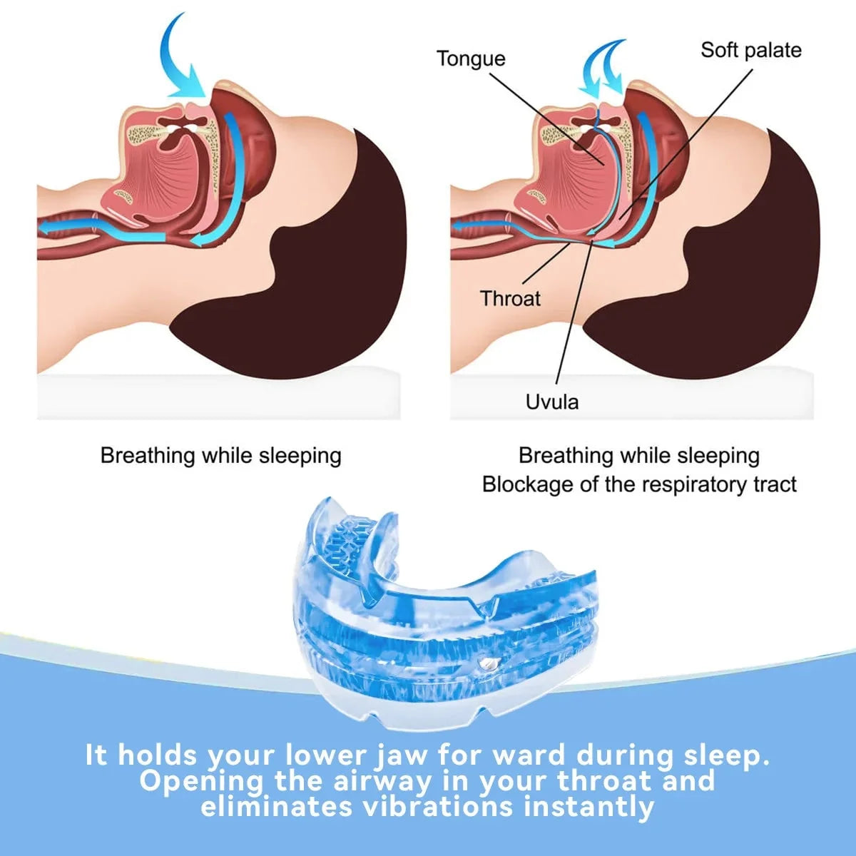 Anti-Snoring Mouthpiece Adjustable Metal Screw Two-Piece Molded Trays