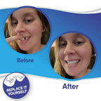 Clip-On Veneers Custom Mold Natural-Looking Upper & Lower