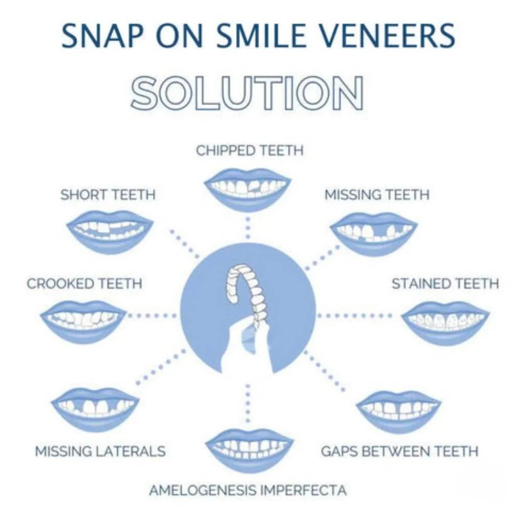 Clip-On Veneers Natural-Looking Upper & Lower