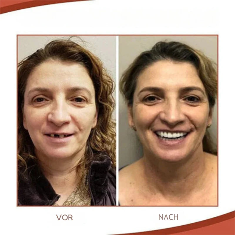 Denture Set Removable Biocompatible Natural-Looking