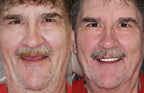 Full Denture Set Moldable Custom Fit Natural-Looking Teeth