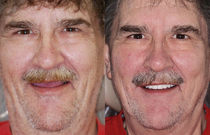 Full Denture Set Moldable Custom Fit Natural-Looking Teeth