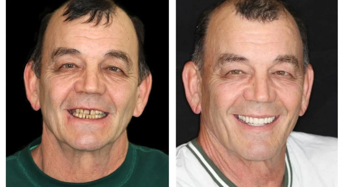 Full Denture Set Moldable Custom Fit Natural-Looking Teeth