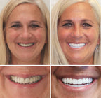 Full Denture Set Moldable Custom Fit Natural-Looking Teeth