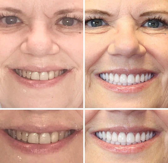 Full Denture Set Moldable Custom Fit Natural-Looking Teeth