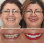 Full Denture Set Moldable Custom Fit Natural-Looking Teeth