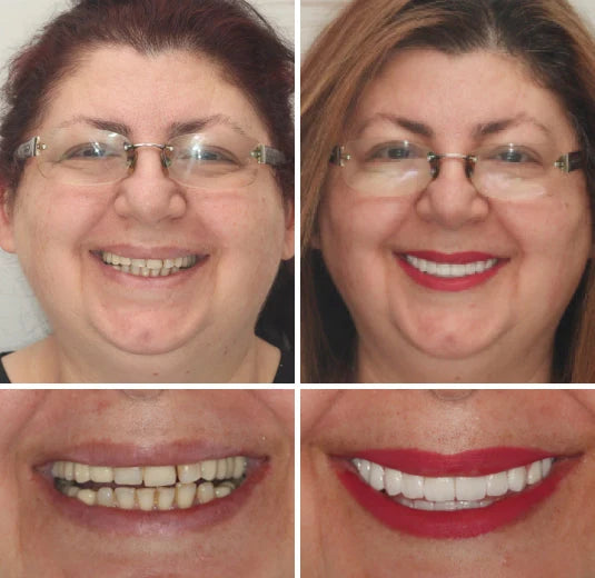 Full Denture Set Moldable Custom Fit Natural-Looking Teeth