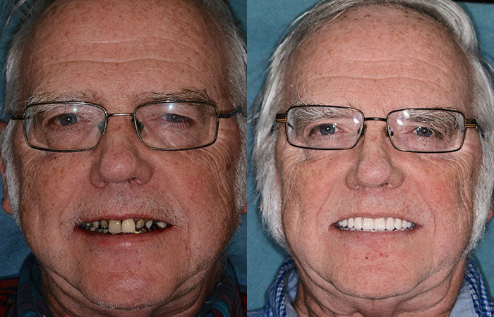 Full Denture Set Moldable Custom Fit Natural-Looking Teeth