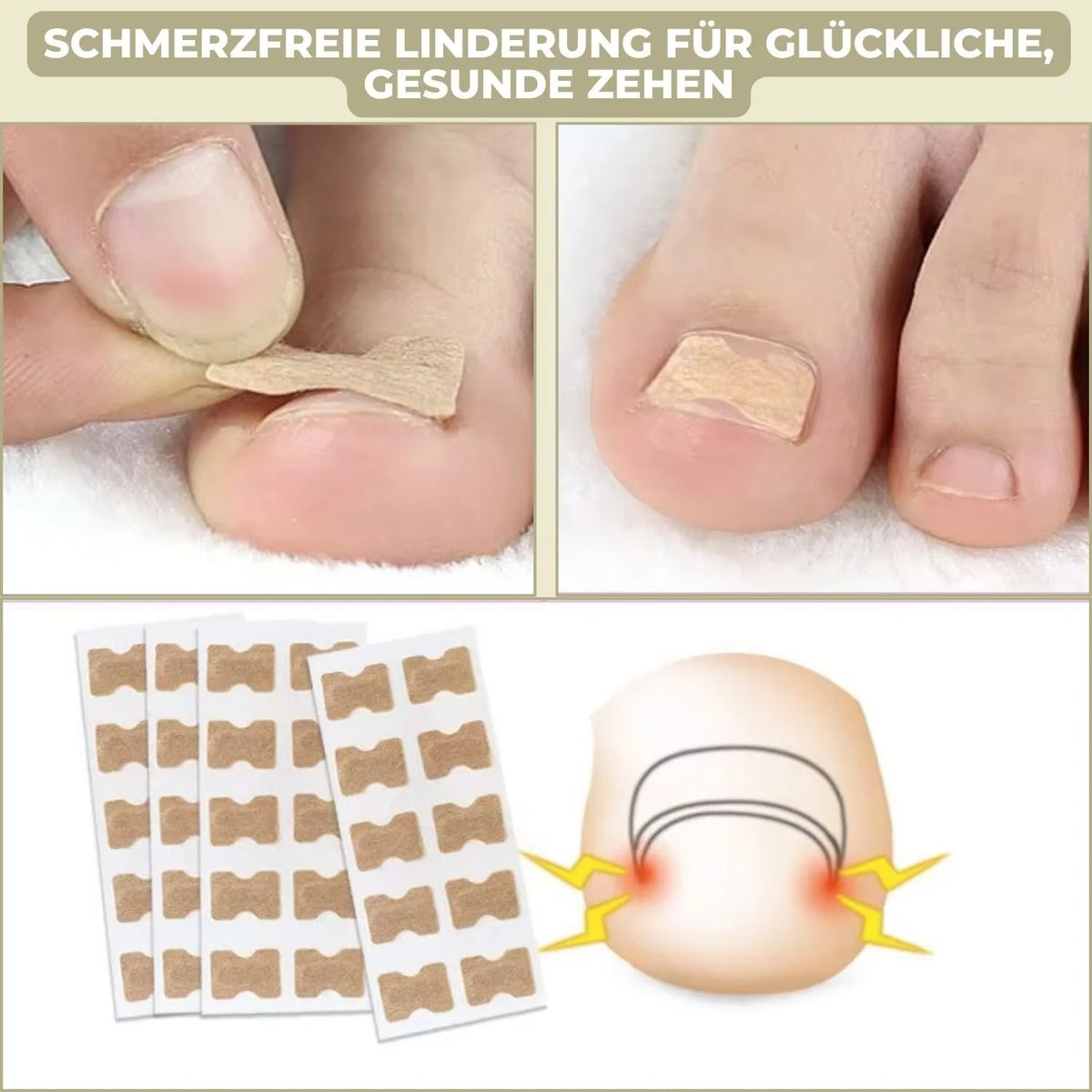 Ingrown Toenail Patches Peel-And-Stick Elastic Fabric Pack Of 20