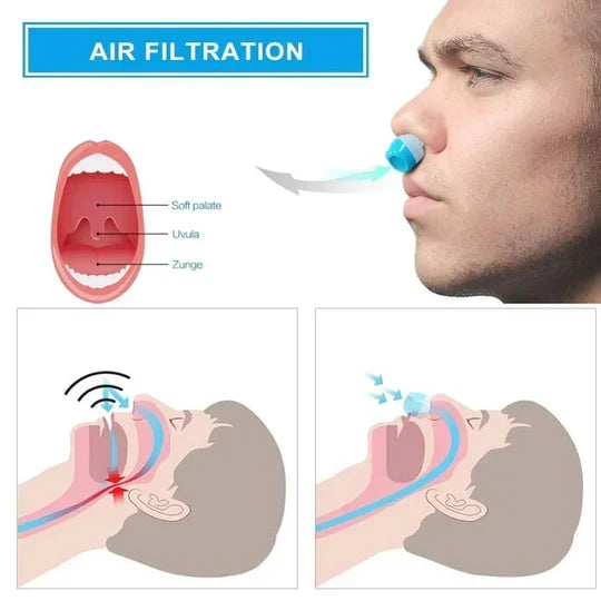 Micro-CPAP Device Compact Noise-Cancelling Comfortable Nasal Seal