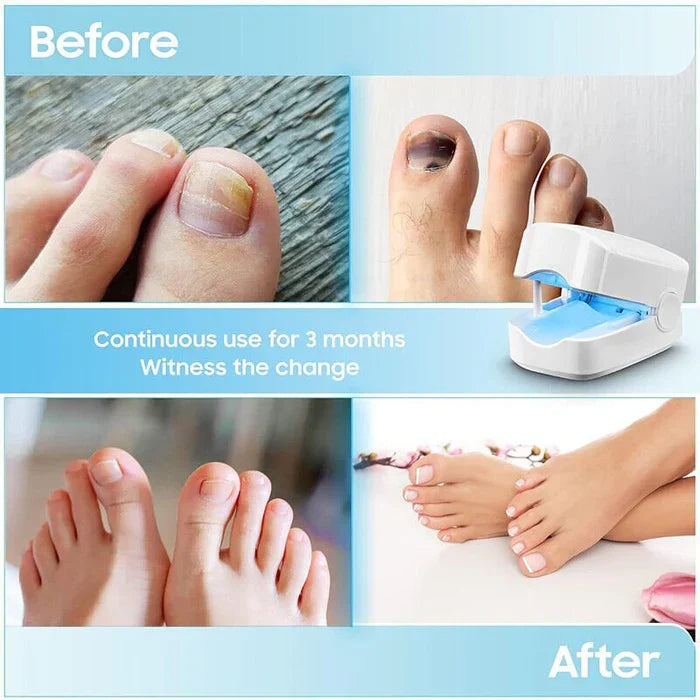 Nail Laser Device Focused Light Rechargeable