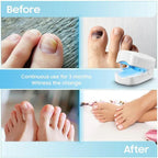 Nail Laser Device Handheld Rechargeable Light Therapy