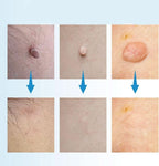 Skin Spot Remover Precision Tip Compact & Ergonomic