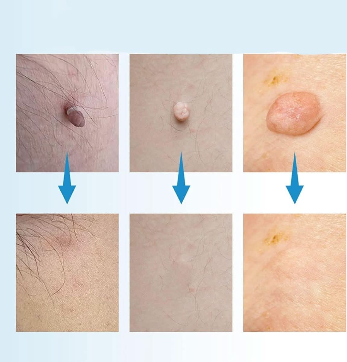 Skin Spot Remover Precision Tip Compact & Ergonomic