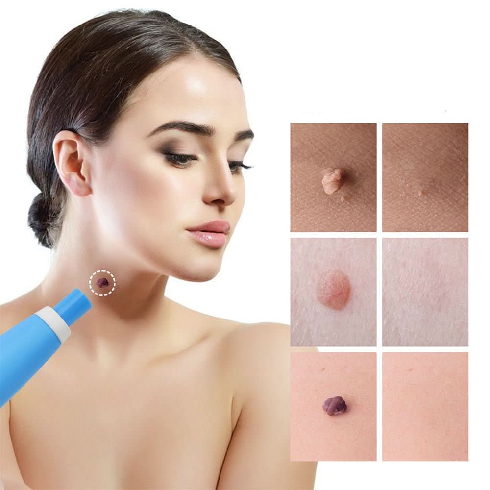 Skin Spot Remover Precision Tip Compact & Ergonomic