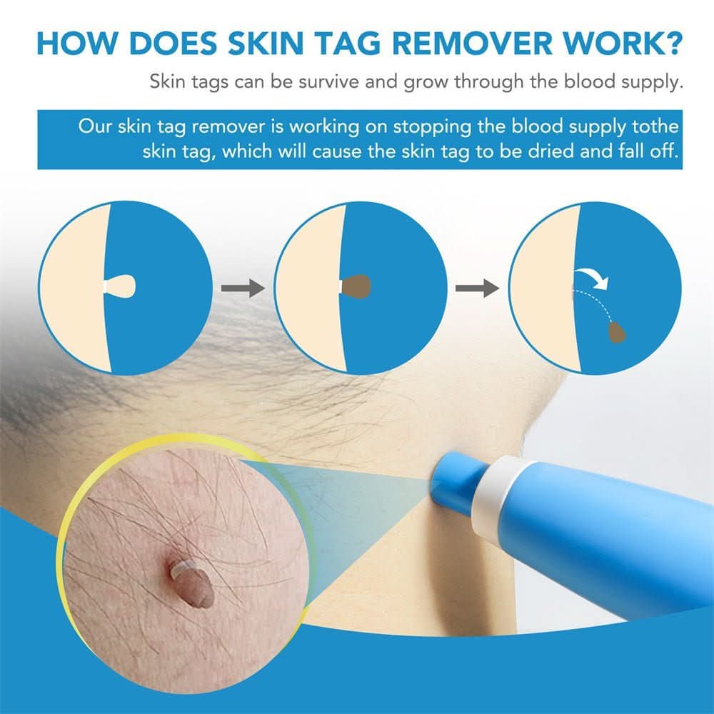 Skin Spot Remover Precision Tip Compact & Ergonomic