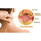 Skin Spray Bee Venom Targeted Spot & Wart Treatment