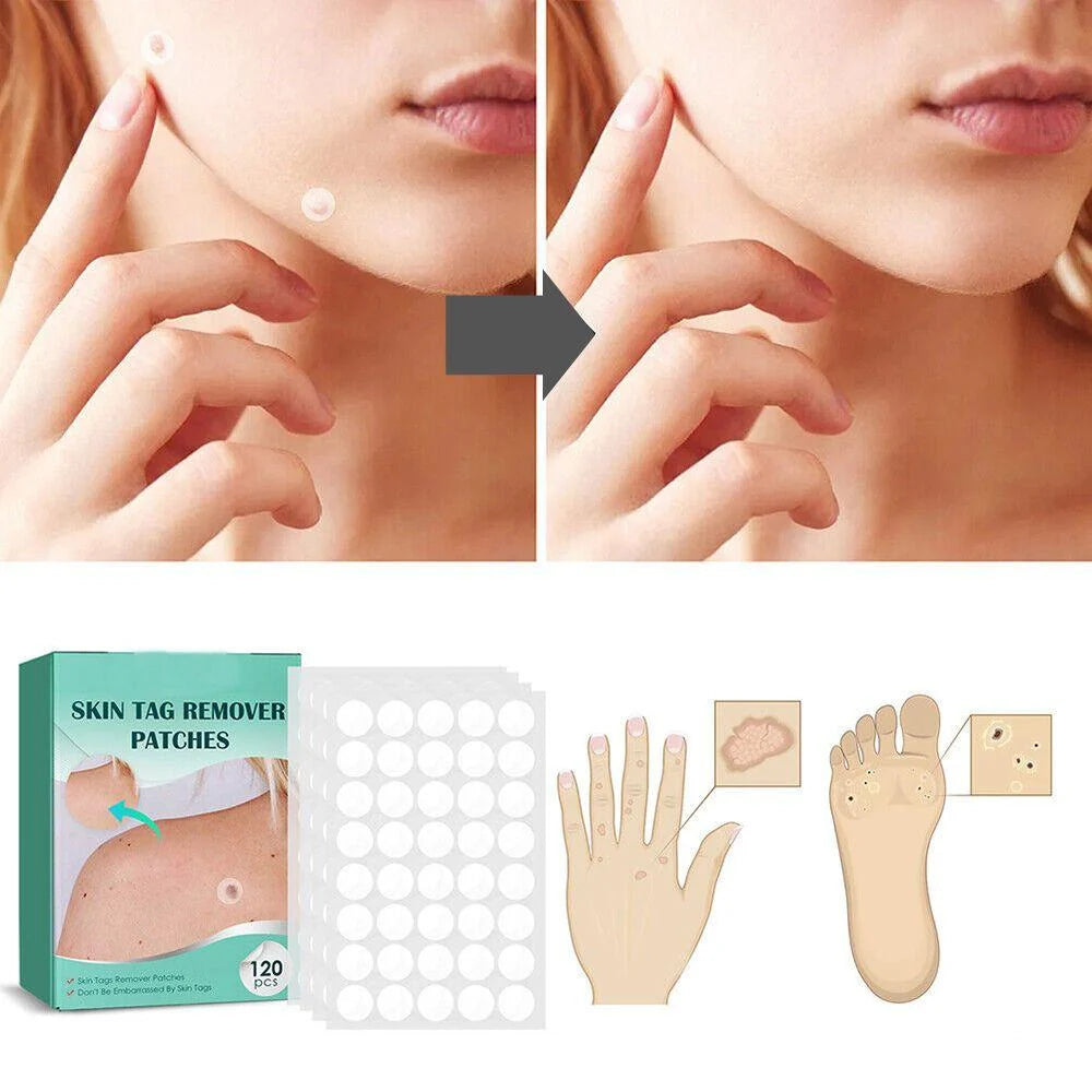 Skin Tag & Wart Patches Hydrocolloid Hypoallergenic 120 Pieces