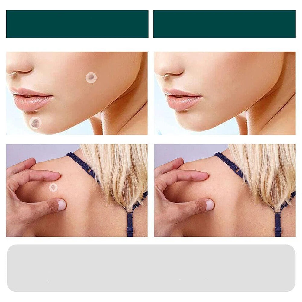 Skin Tag & Wart Patches Hydrocolloid Hypoallergenic 120 Pieces