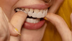 Snap-On Veneers Custom Fit Reusable