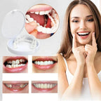 Snap-On Veneers Moldable Custom-Fit Removable Upper & Lower