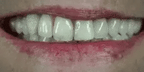 Snap-On Veneers Moldable Custom-Fit Removable Upper & Lower