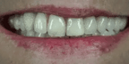 Snap-On Veneers Moldable Custom-Fit Upper & Lower Coverage
