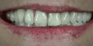Snap-On Veneers Moldable Custom-Fit Upper & Lower Coverage