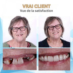 Snap-On Veneers Silicone-Lined Moldable Upper & Lower Set