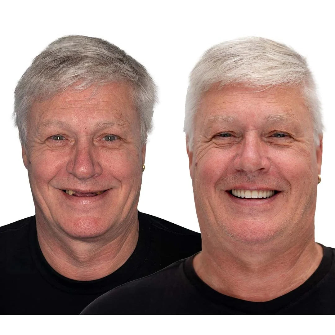 Temporary Dentures Soft Cushion Snap-In Upper & Lower Set