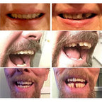 Temporary Teeth Cover Slip-On Natural-Looking Lightweight