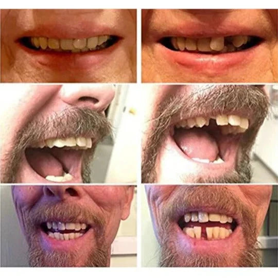 Temporary Teeth Cover Slip-On Natural-Looking Lightweight
