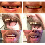 Temporary Veneers Snap-In Natural-Looking Non-Toxic