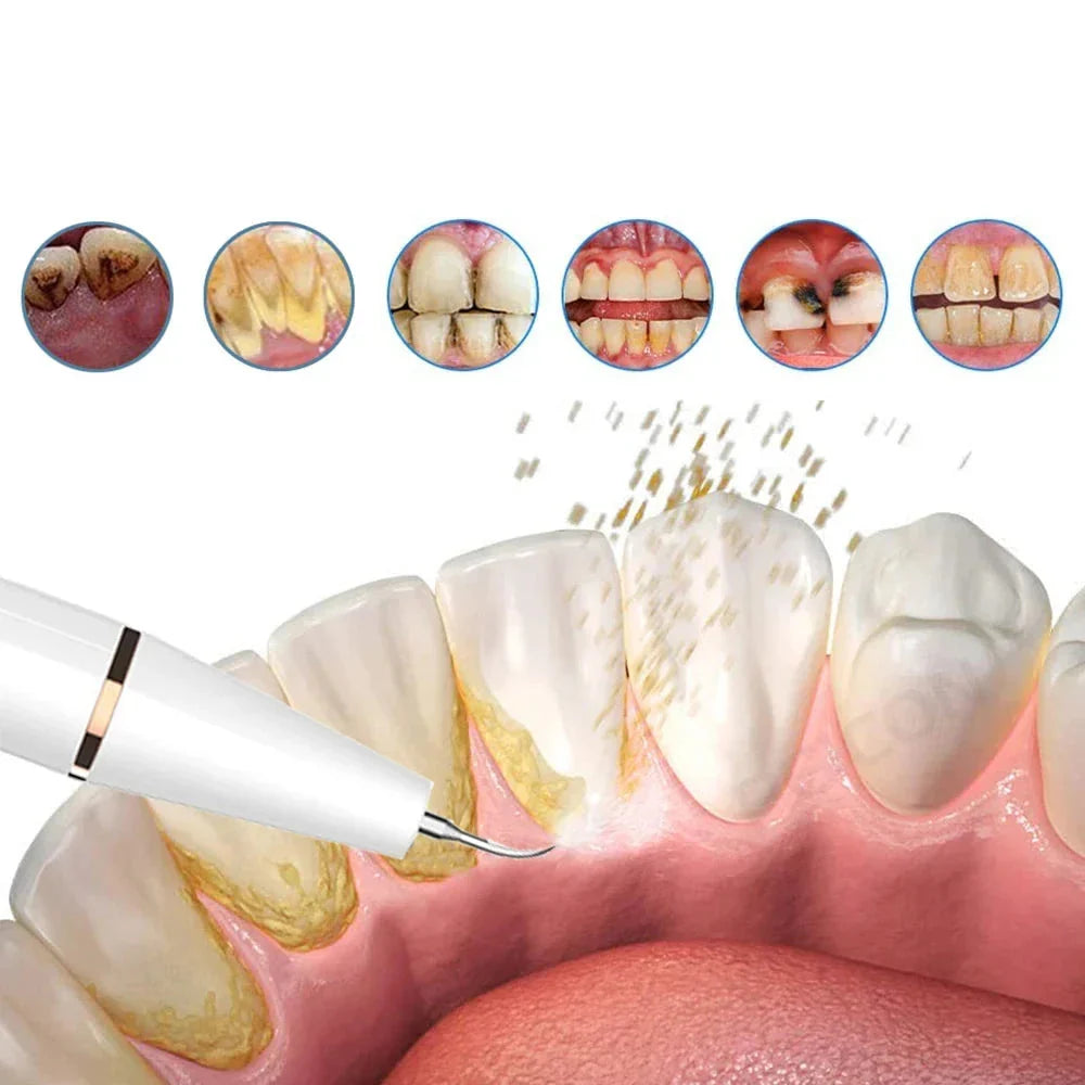Tooth Cleaner Ultrasonic Cordless Rechargeable & Gentle On Gums