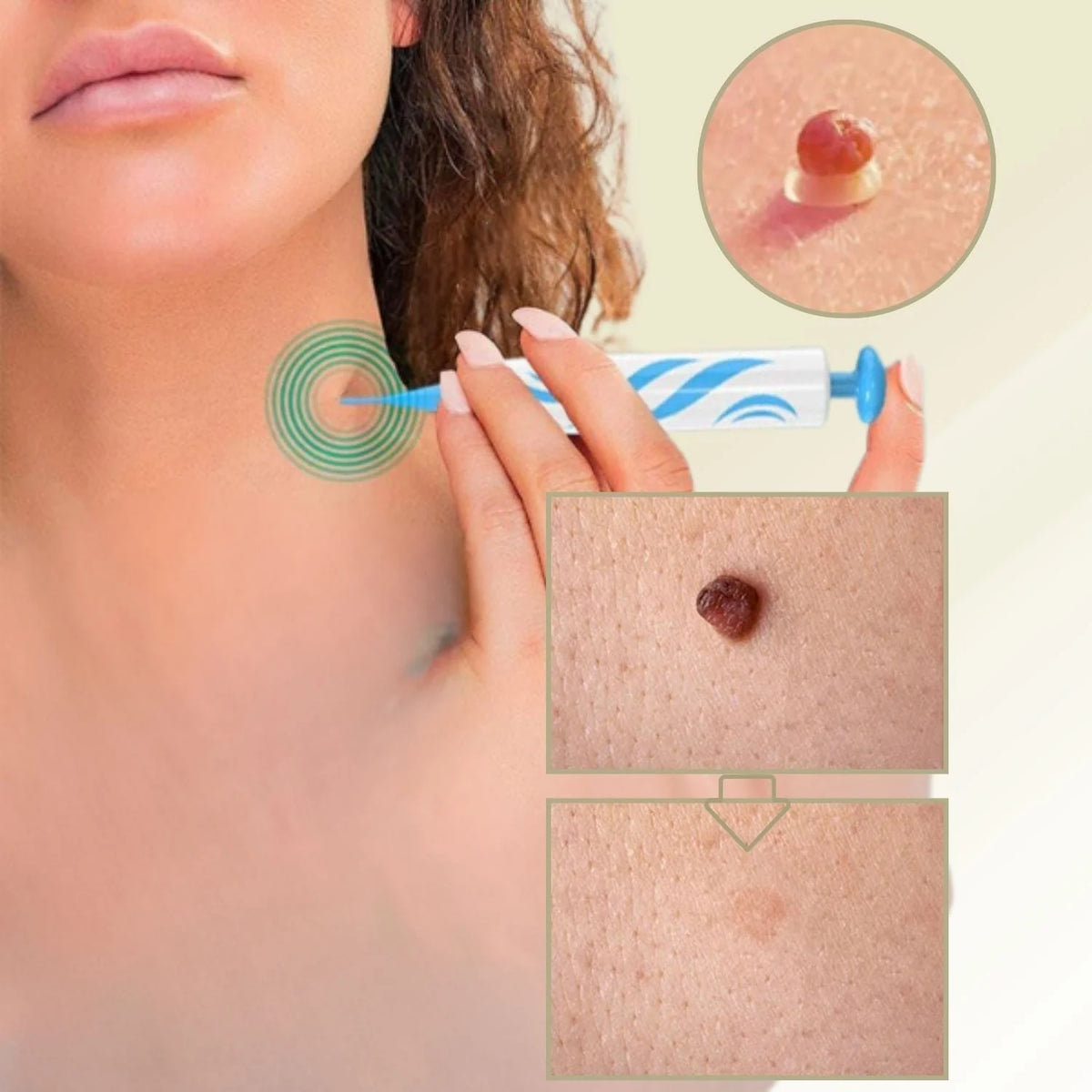 Wart & Mole Remover Topical Non-Invasive 50 ml